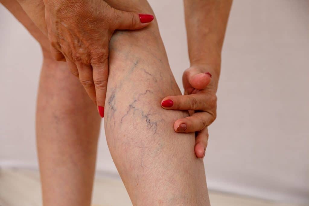 An elderly woman in white panties is touching her legs with varicose veins
